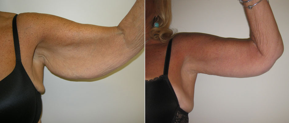 Arm Lift Before & After Photo
