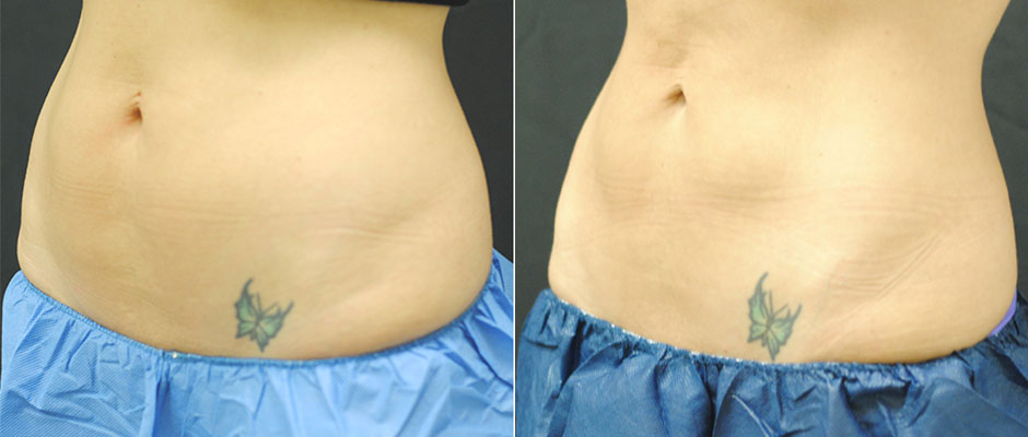 CoolSculpting for Women Before & After Photo