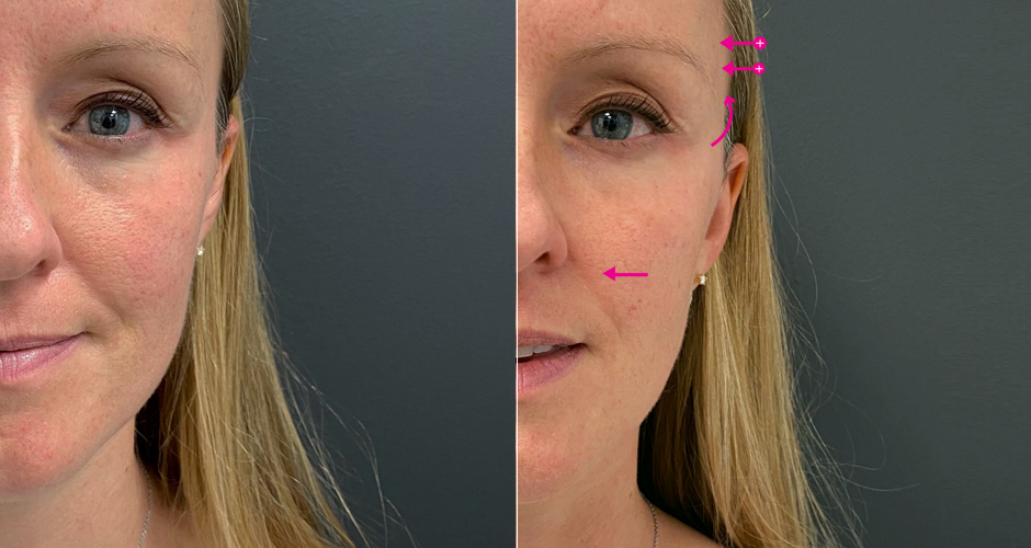 Dermal Fillers Before & After Photos
